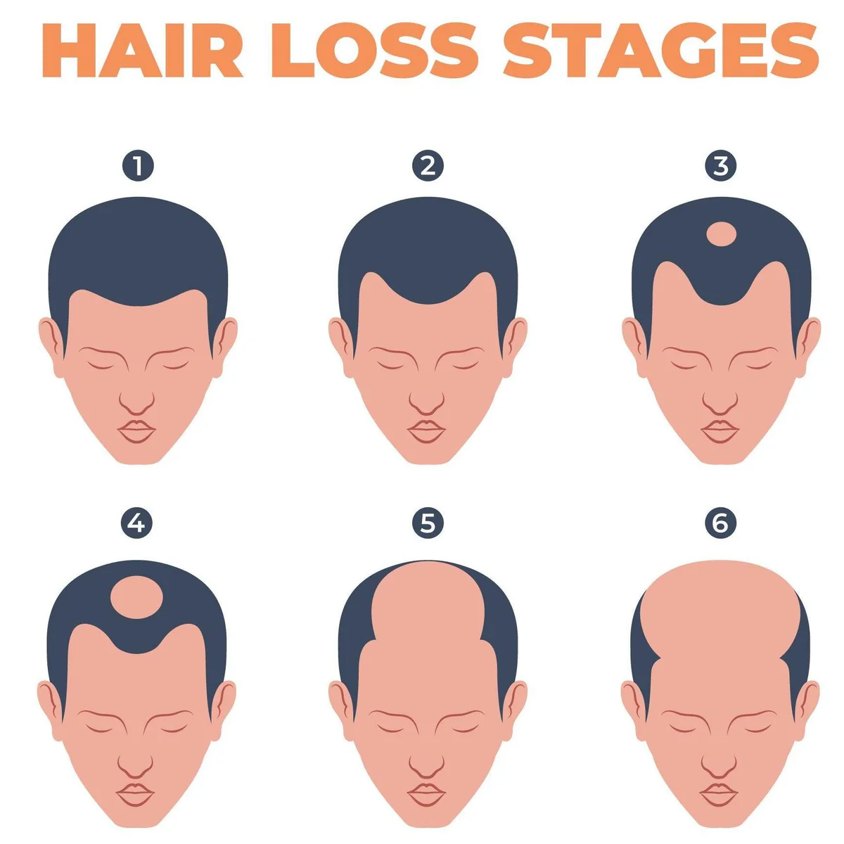 HAIR LOSS STAGES